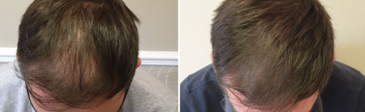tattoos for thinning hair