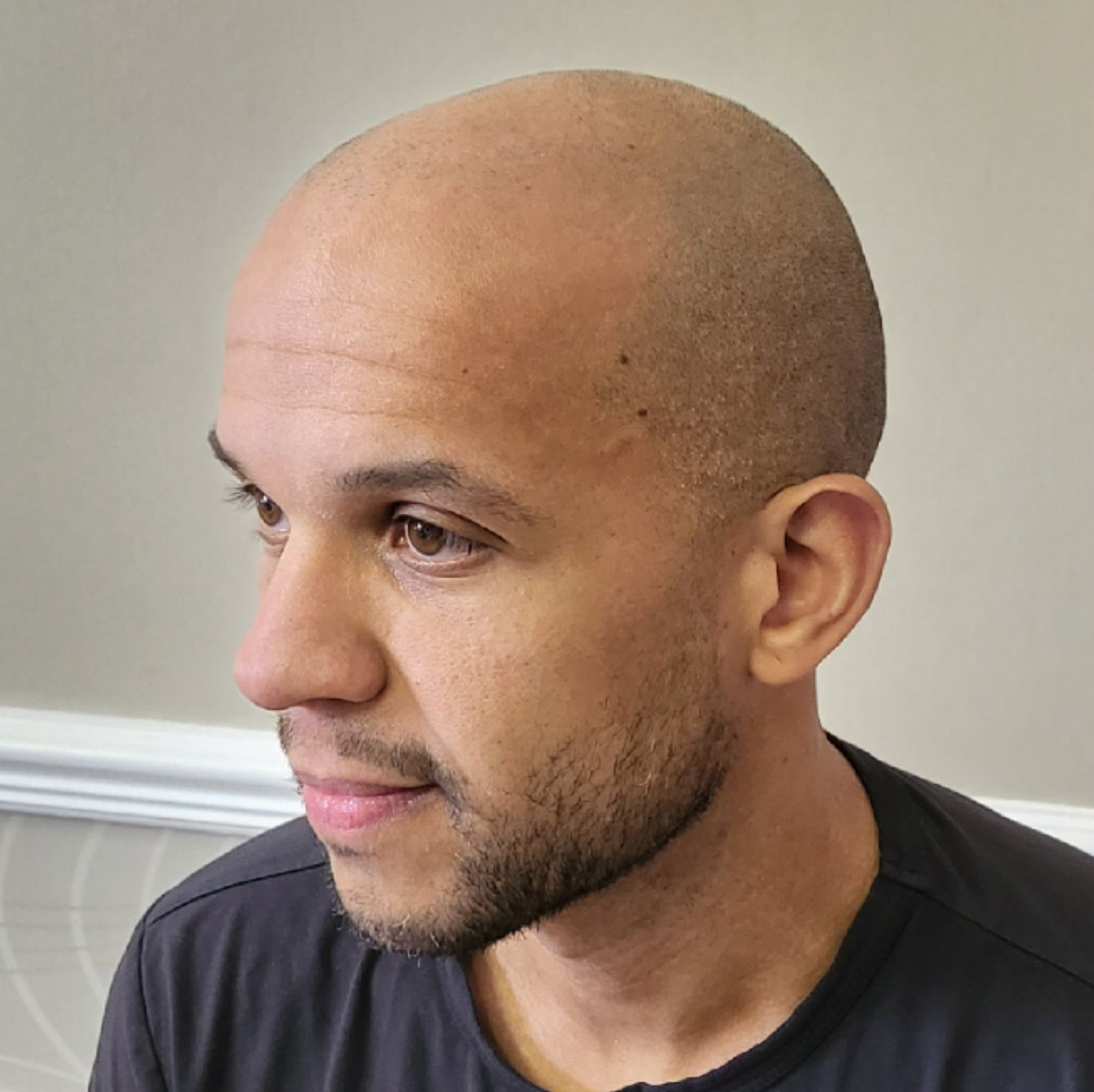 scalp pigmentation for male pattern baldness before