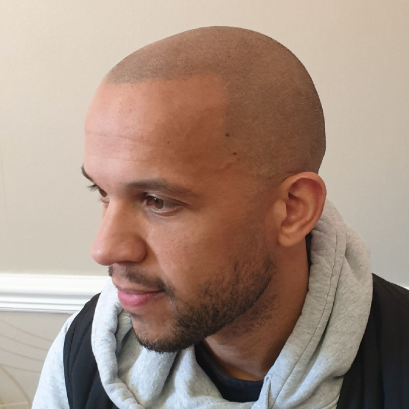 scalp pigmentation for male pattern baldness after