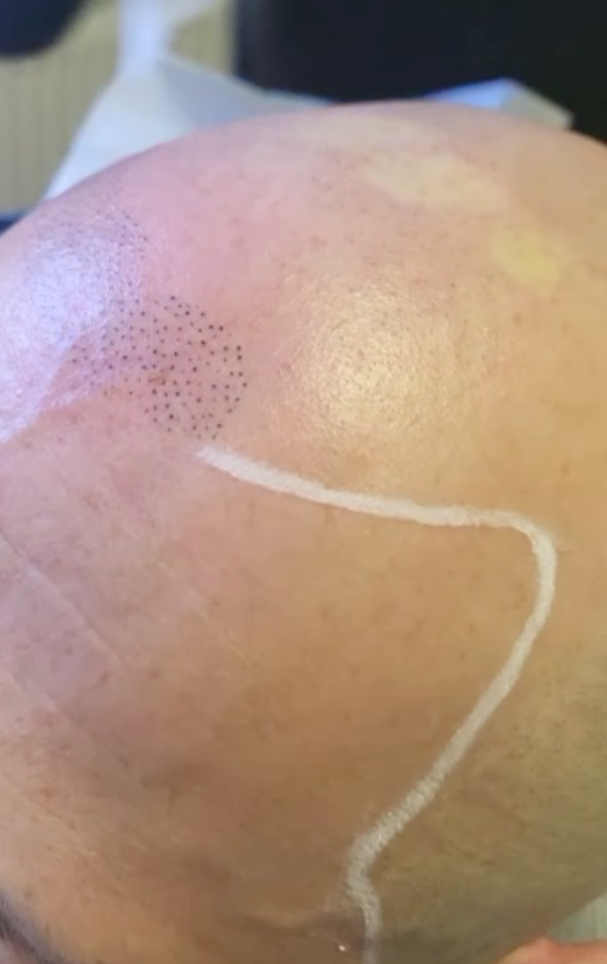 SMP receding hairline treatment