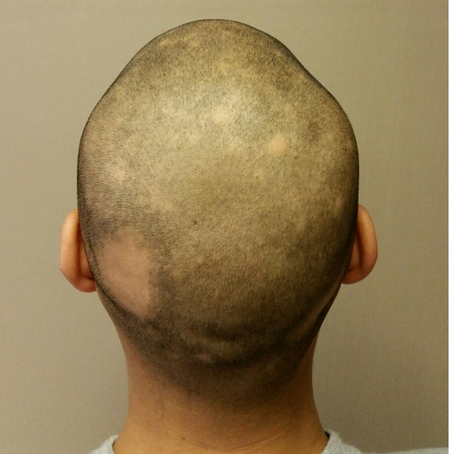 Alopecia Tattoo Hair Before