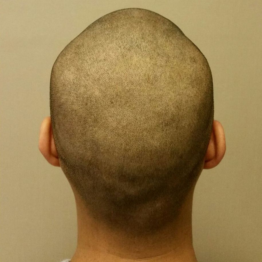 Alopecia Tattoo Hair After