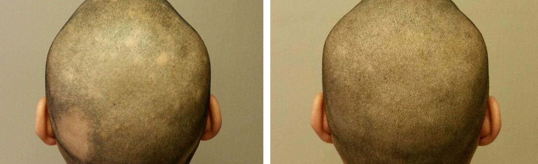 alopecia hair tattoos
