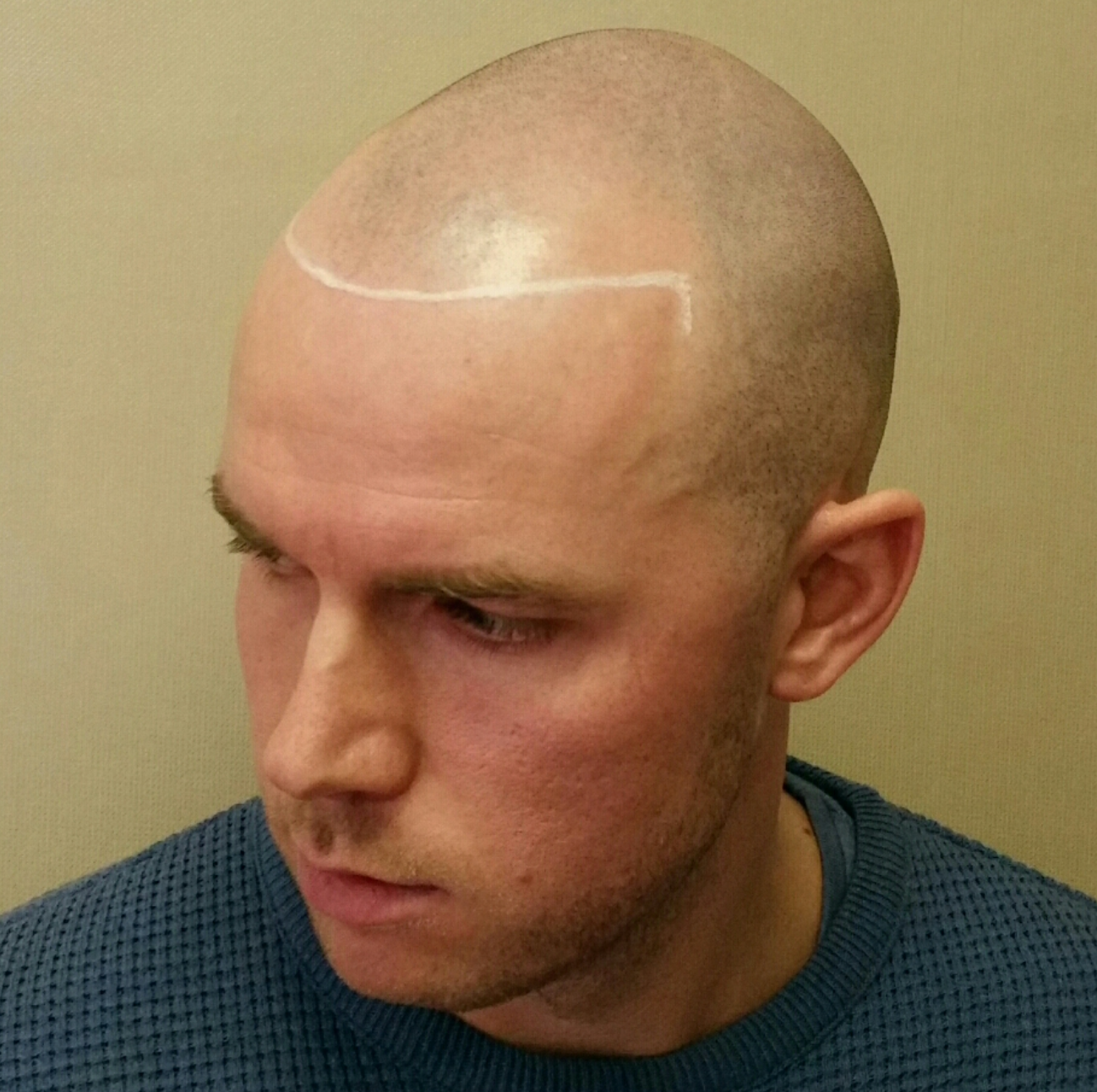 hairline tattoo for receding hairline before