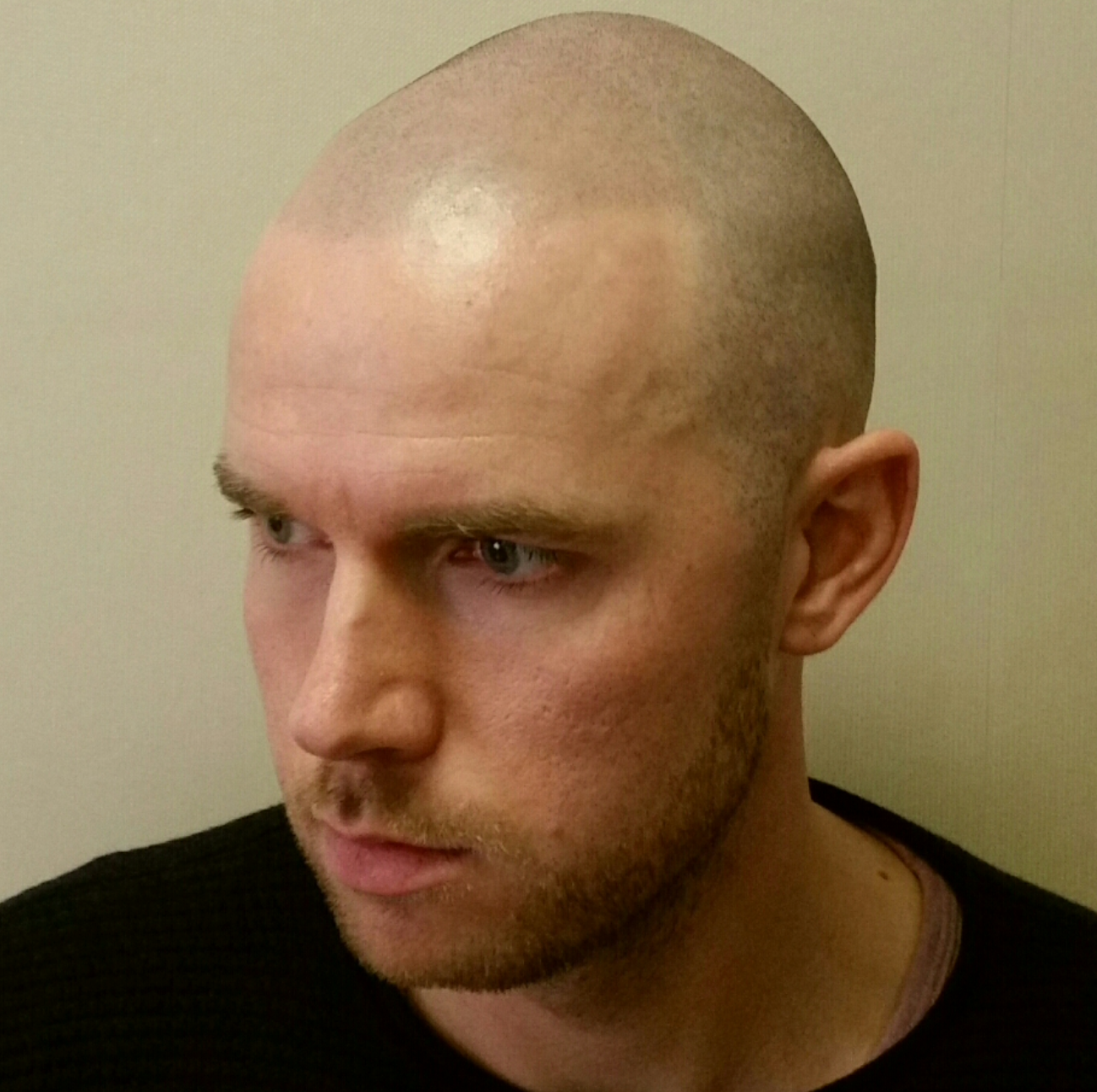 hairline tattoo for receding hairline after