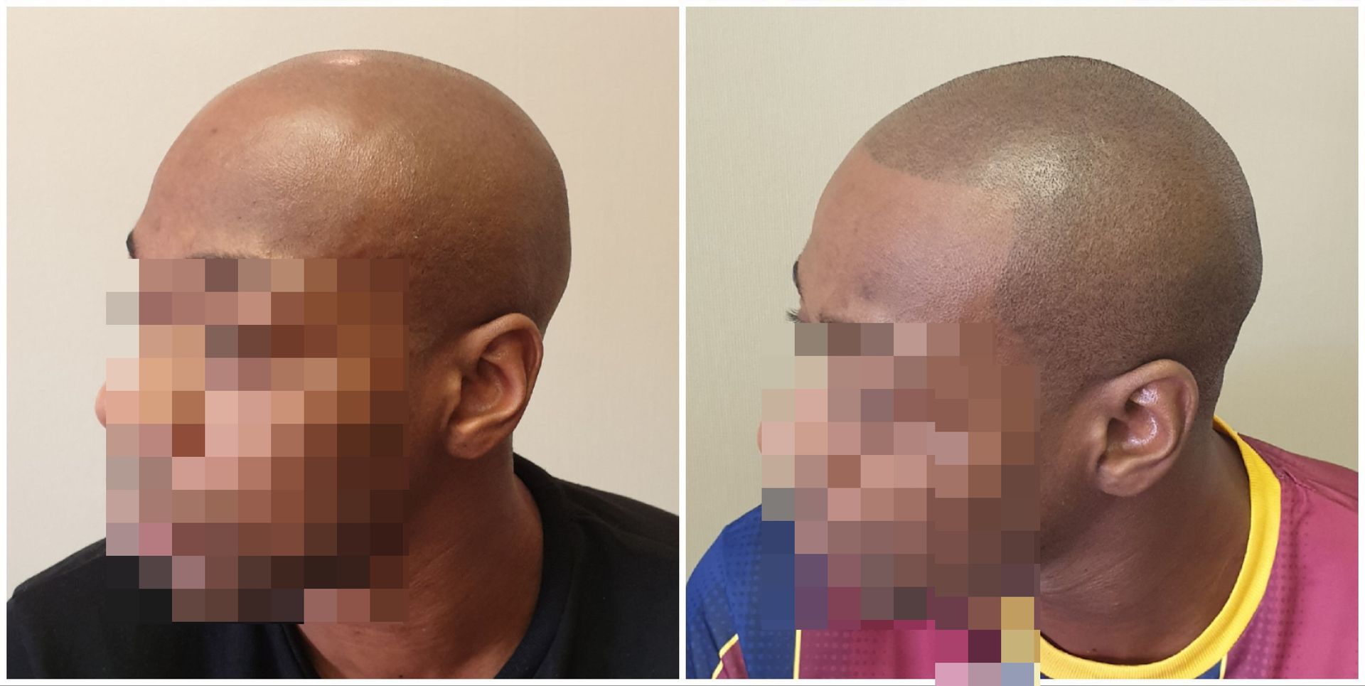 SMP hairline Before and After Results