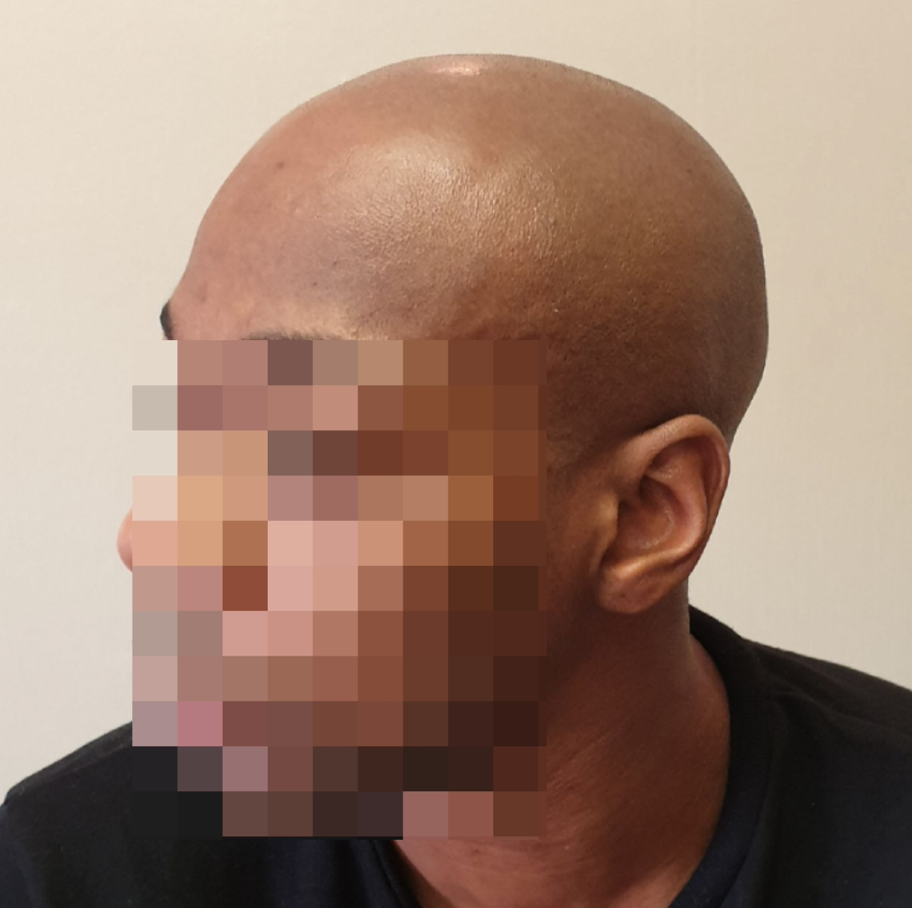 SMP for male pattern baldness before