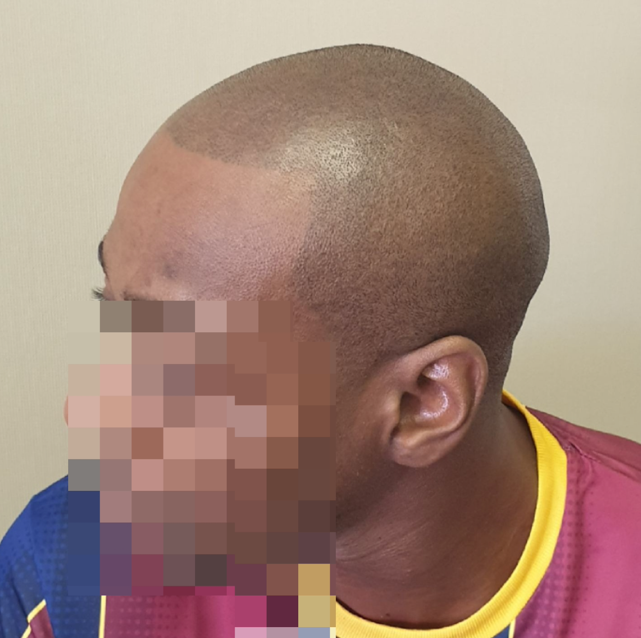 SMP for male pattern baldness after