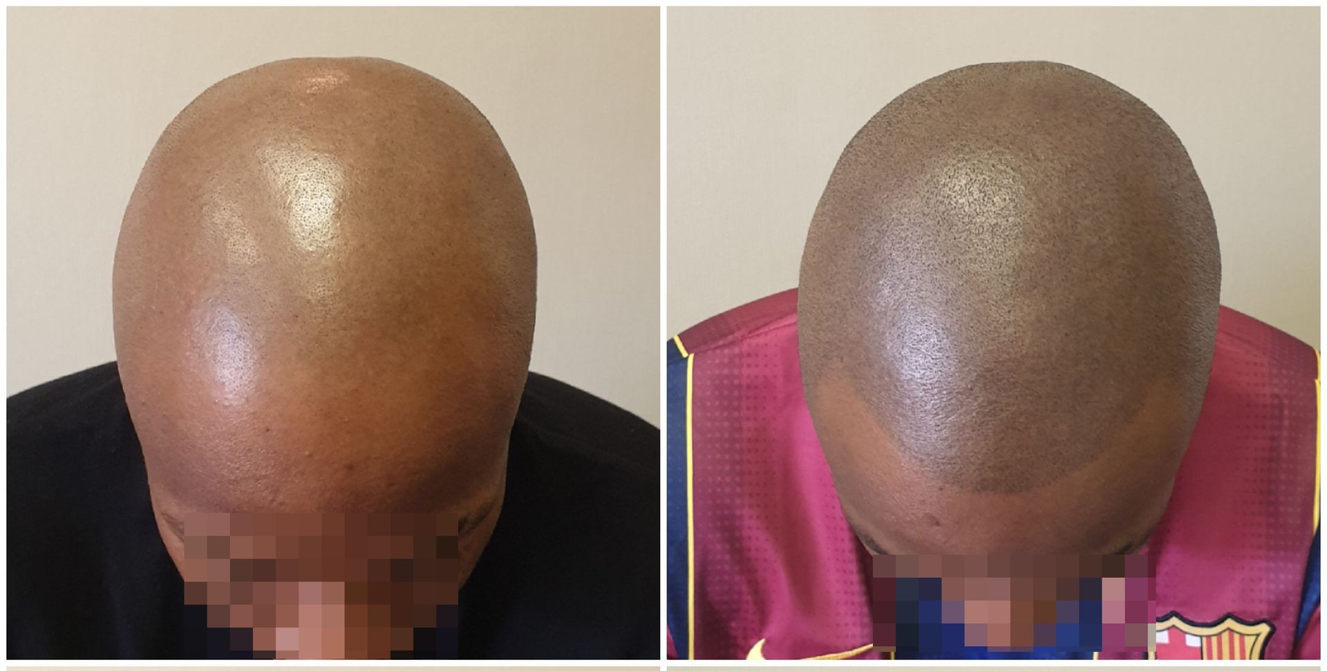 SMP For Men - Receding Hairline