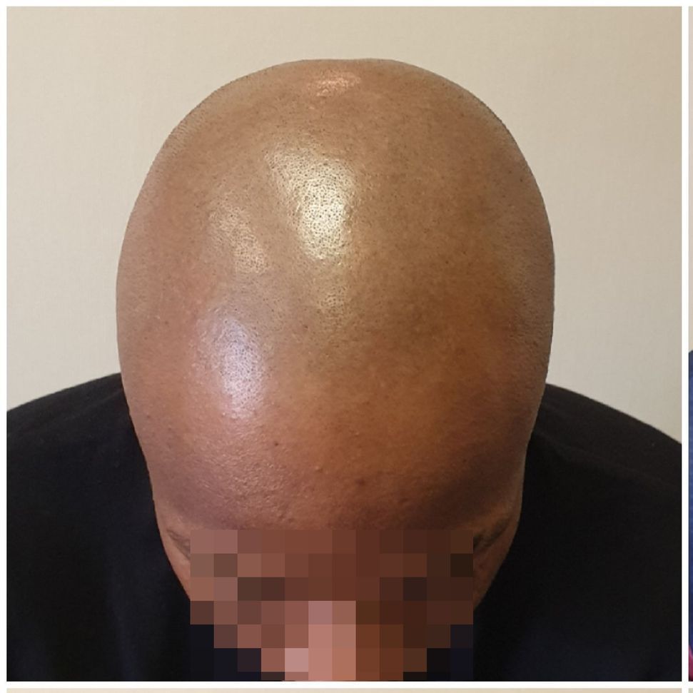 Scalp Micropigmentation Before