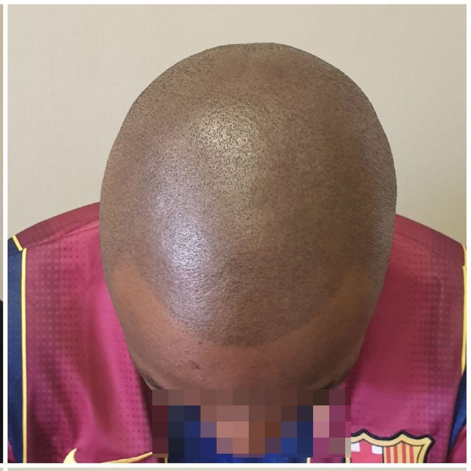 Scalp Micropigmentation After