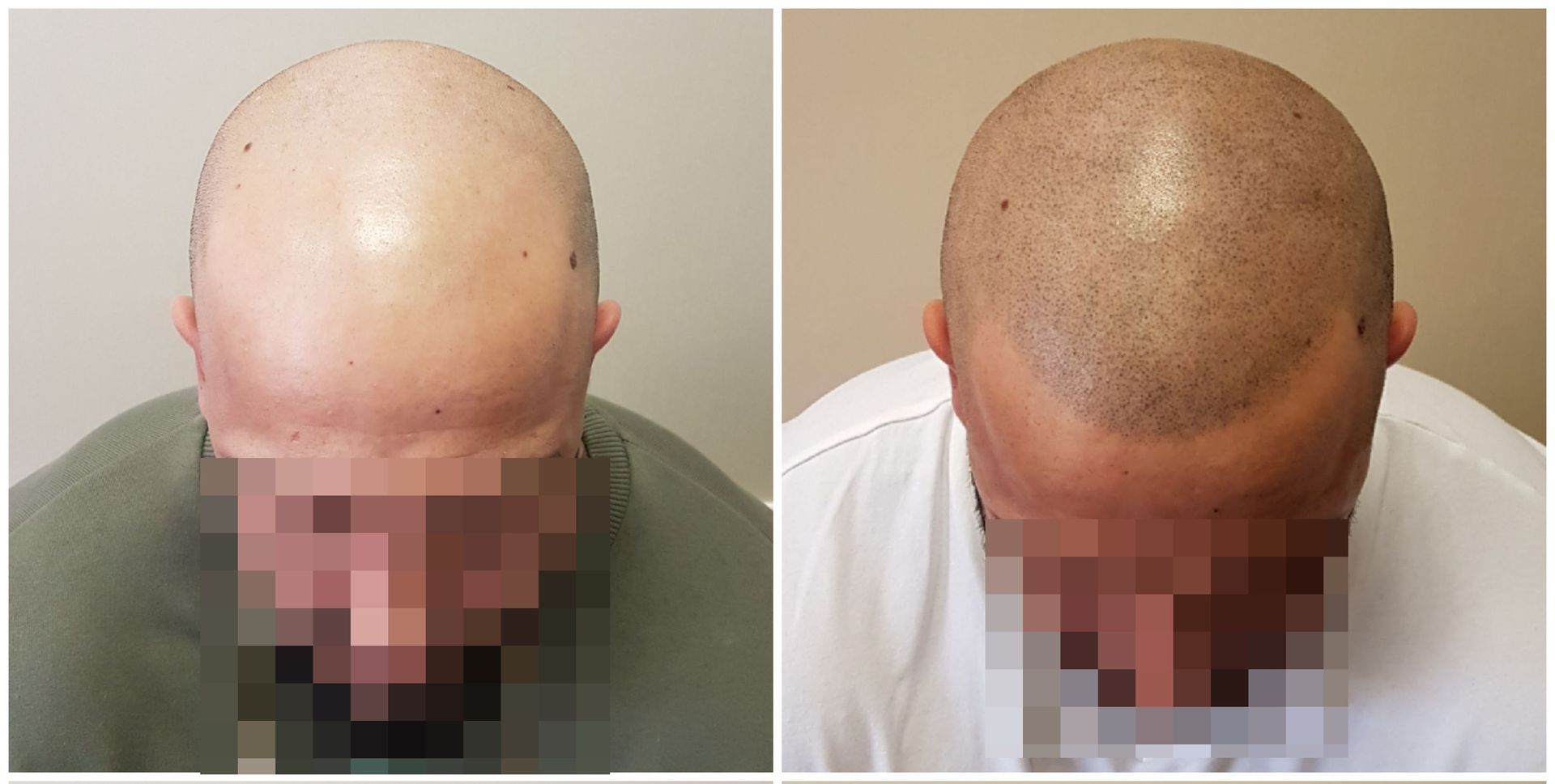 SMP shaved head result
