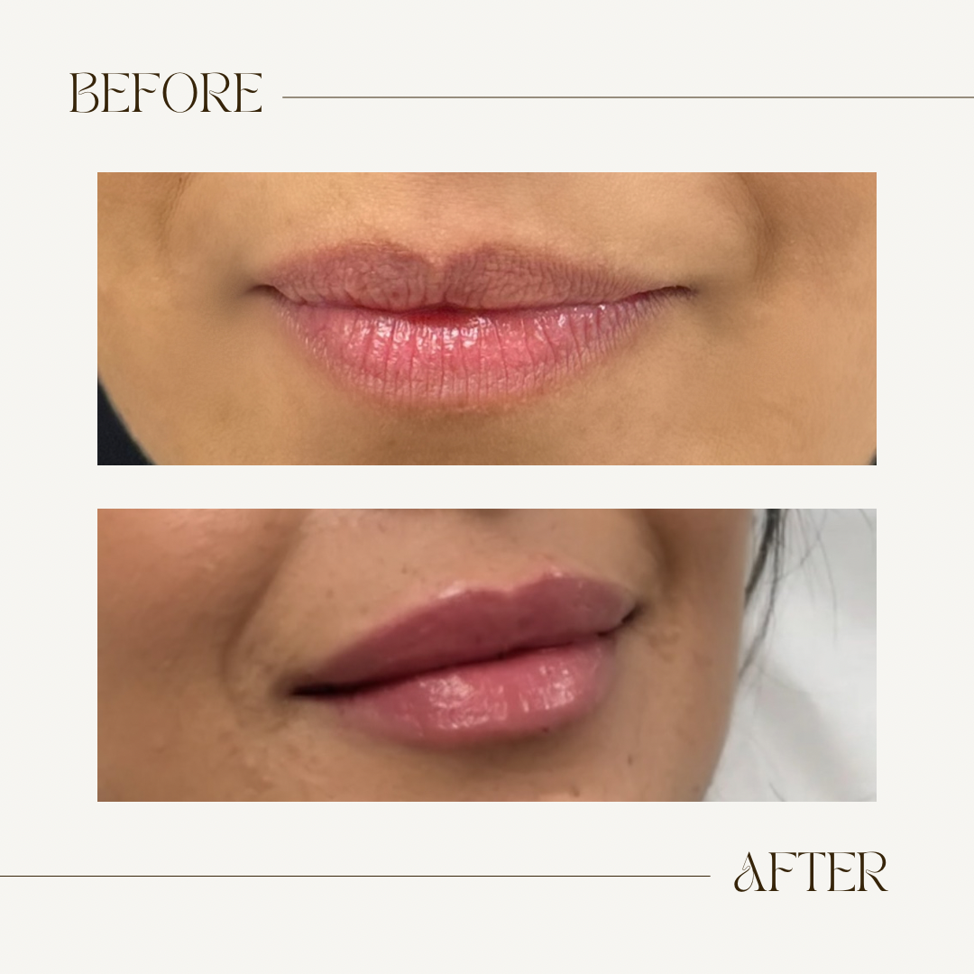 A before and after photo of a woman 's lips.