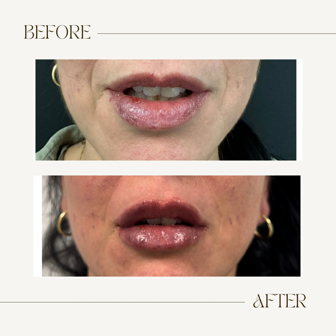 A before and after photo of a woman 's lips.
