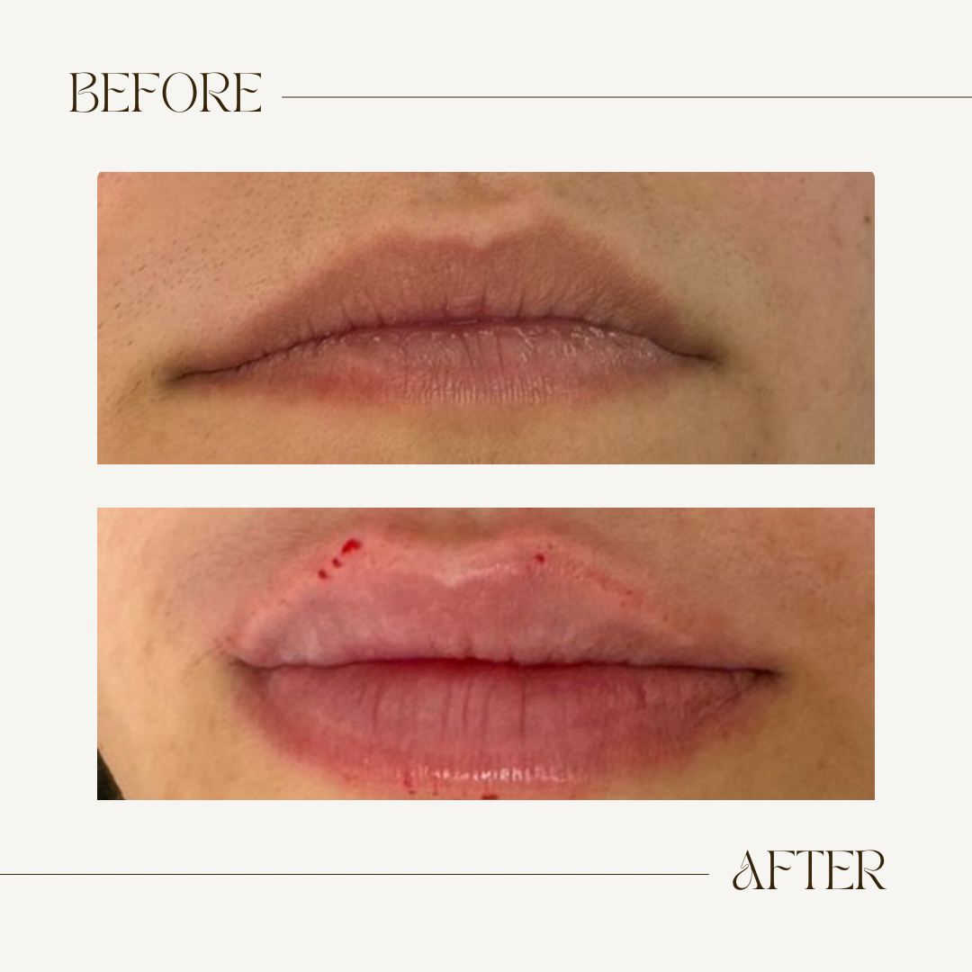 A before and after picture of a woman 's lips.