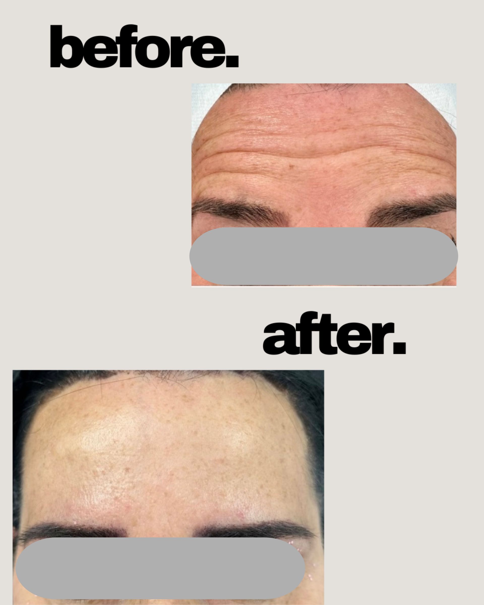 A before and after picture of a man 's forehead