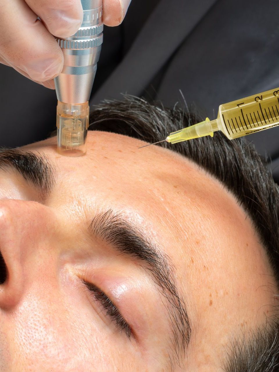 A man is getting an injection in his forehead with a syringe.