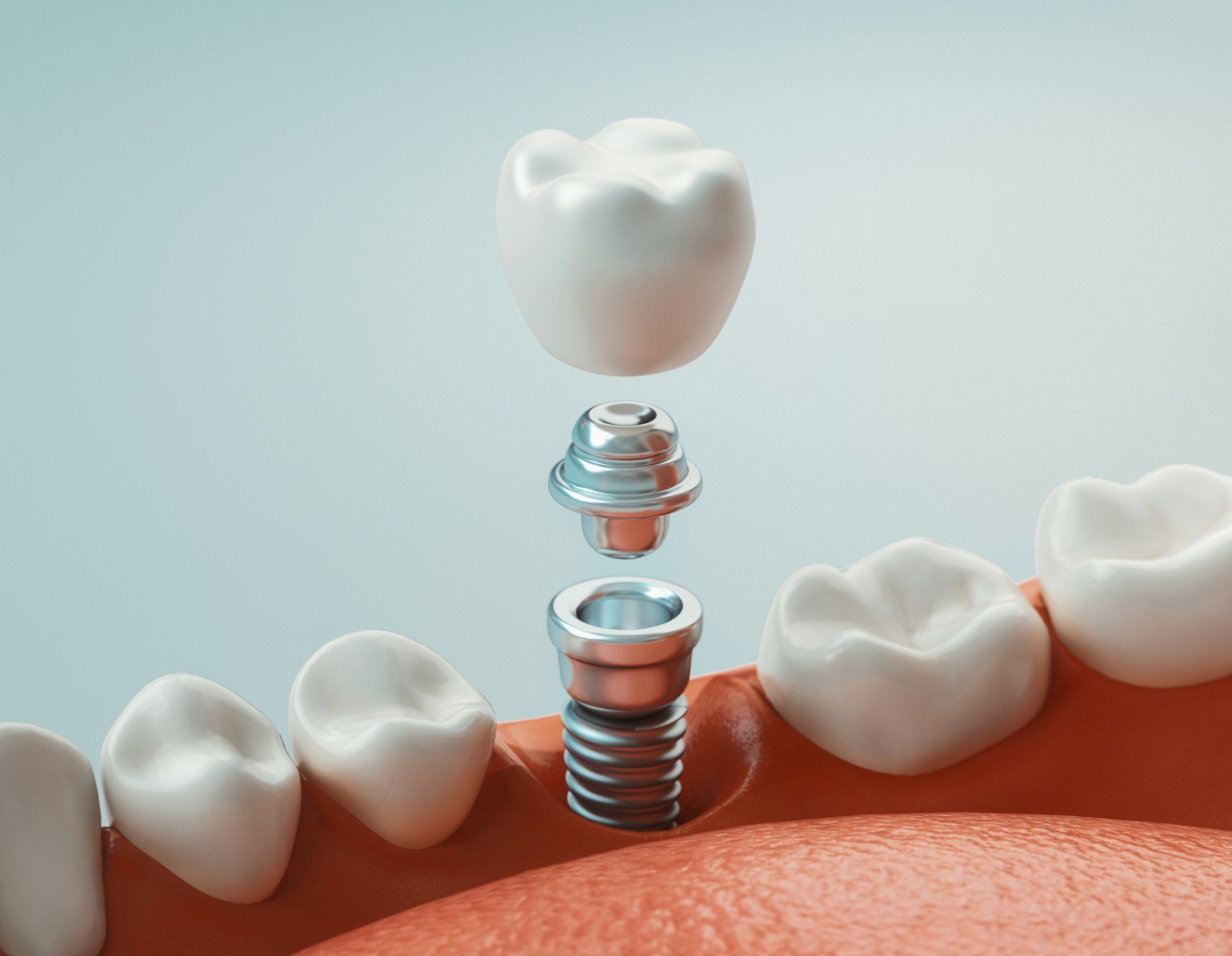 Crowns & Bridges — Armadale, WA — Lee & Mak Dental