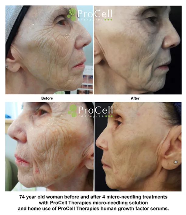 Before-and-after side profile photos showing reduced facial wrinkles and sagging after treatment