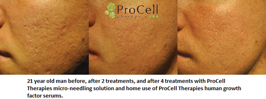Side-by-side facial skin close-ups showing acne before and after ProCell therapy; reduced redness and blemishes