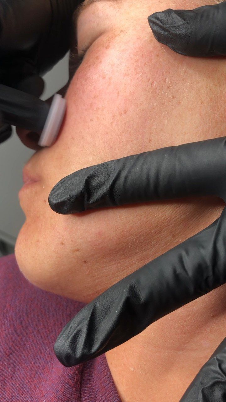 Gloved hands examining a person's cheek with a small handheld device