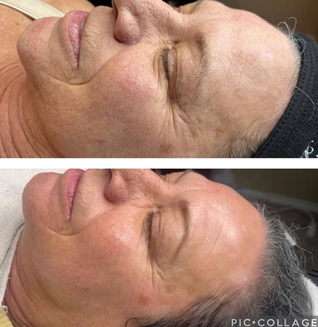 Before-and-after close-up of a woman’s face, showing smoother skin in the lower image.