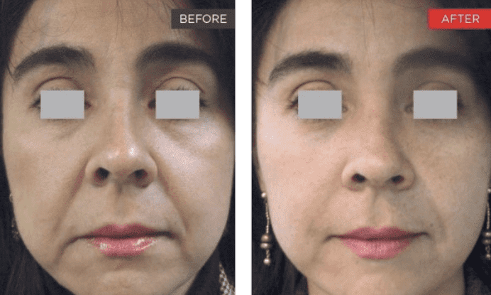 Fotona 4D Laser FaceLift