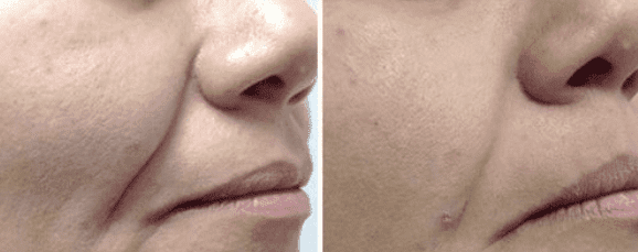 A before and after photo of a woman 's face.