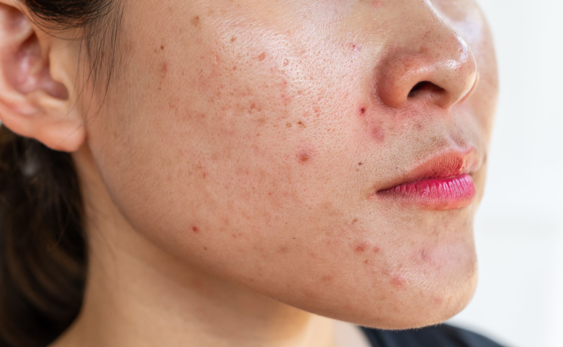 Close-up of a person’s face with visible acne and skin blemishes on the cheek and jawline