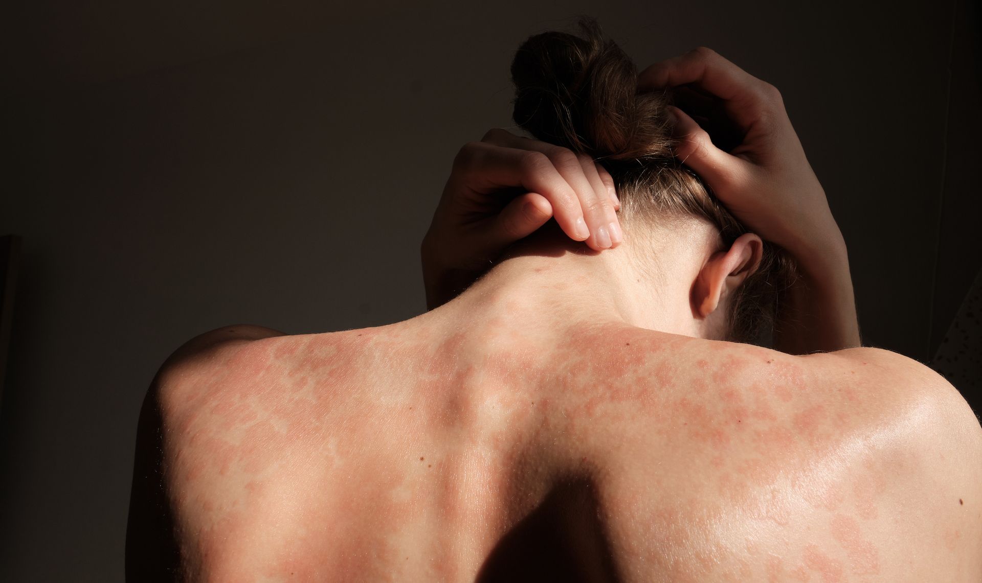 Person scratching the back of their neck and scalp, with red irritated skin on the shoulders and neck.