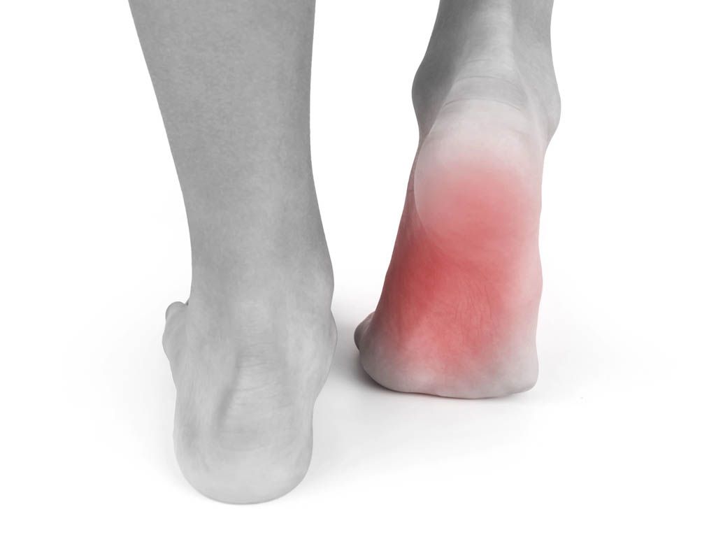 Plantar Fasciitis Parkstone osteopaths