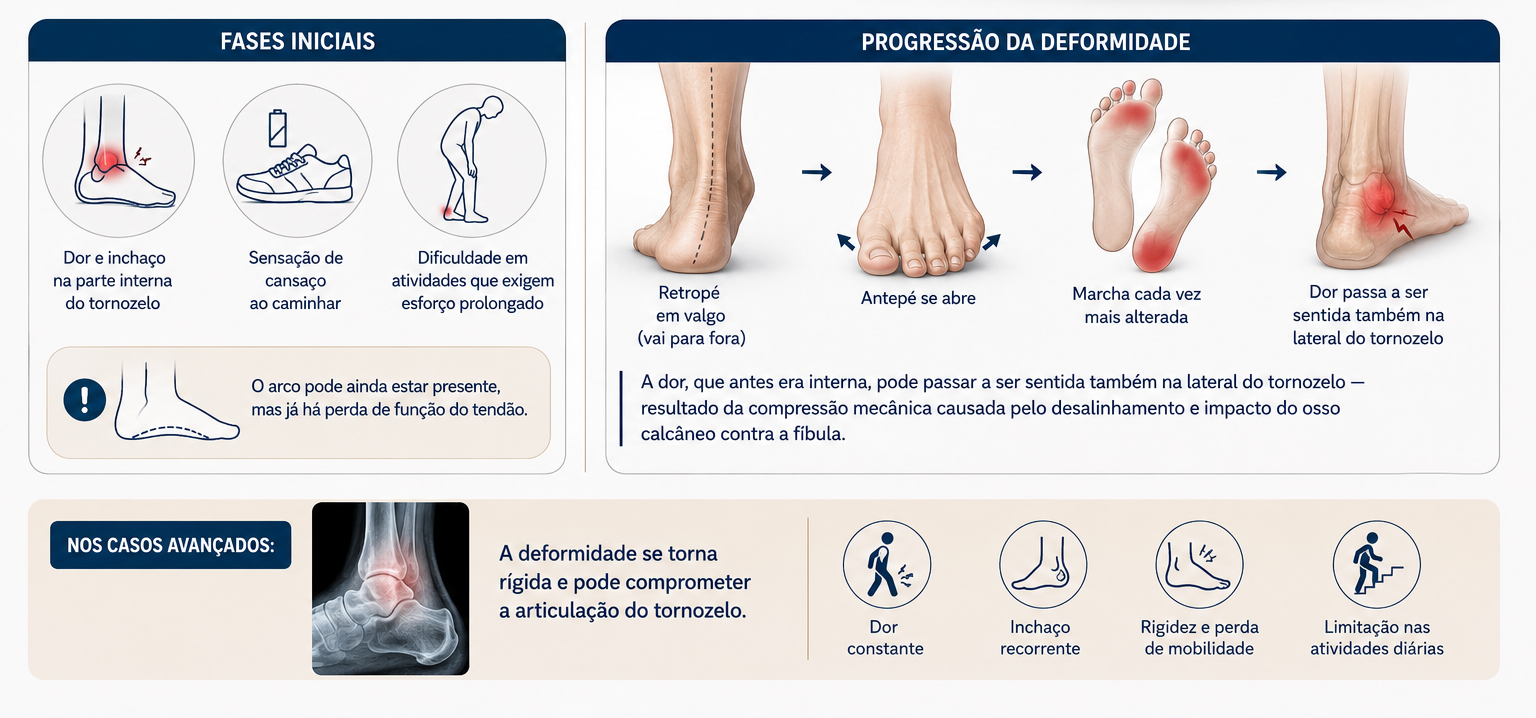 Infográfico sintomas pé plano – progressão da deformidade e impacto na marcha