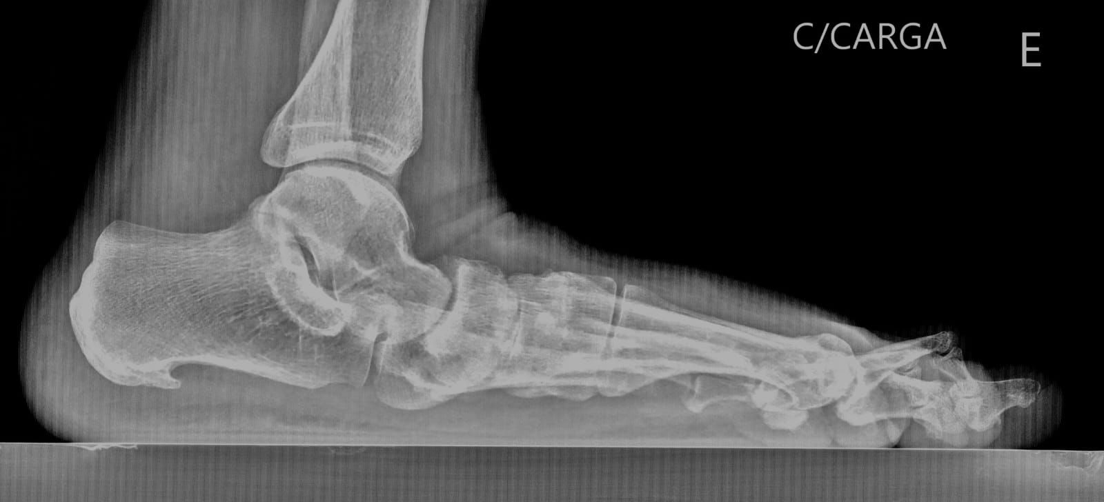 Radiografia de pé plano com carga – Dr. Vinícius Bertelli, Ribeirão Preto