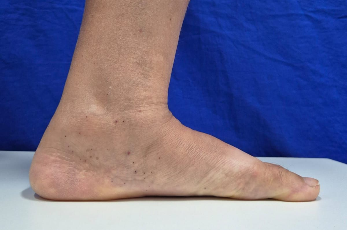 Pé plano adulto – colapso do arco longitudinal medial, vista lateral