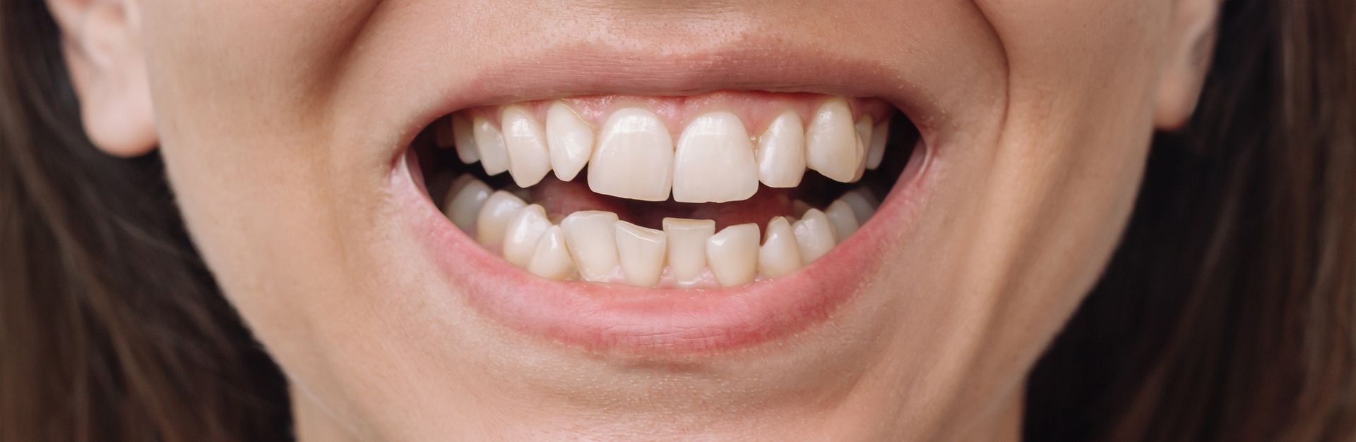 cosmetic dentistry before photo Naples FL patient David O'Sullivan DMD