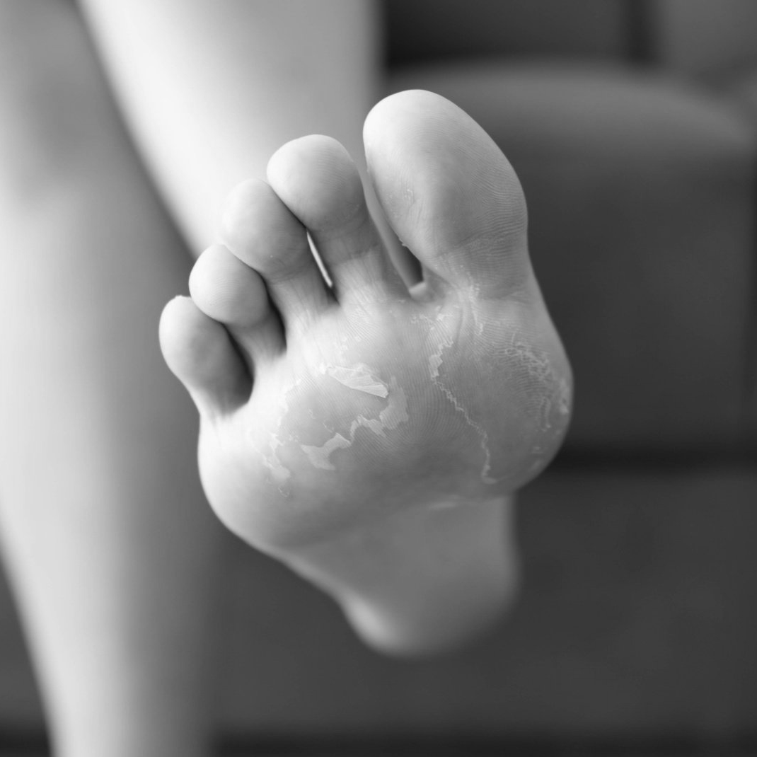athlete's foot