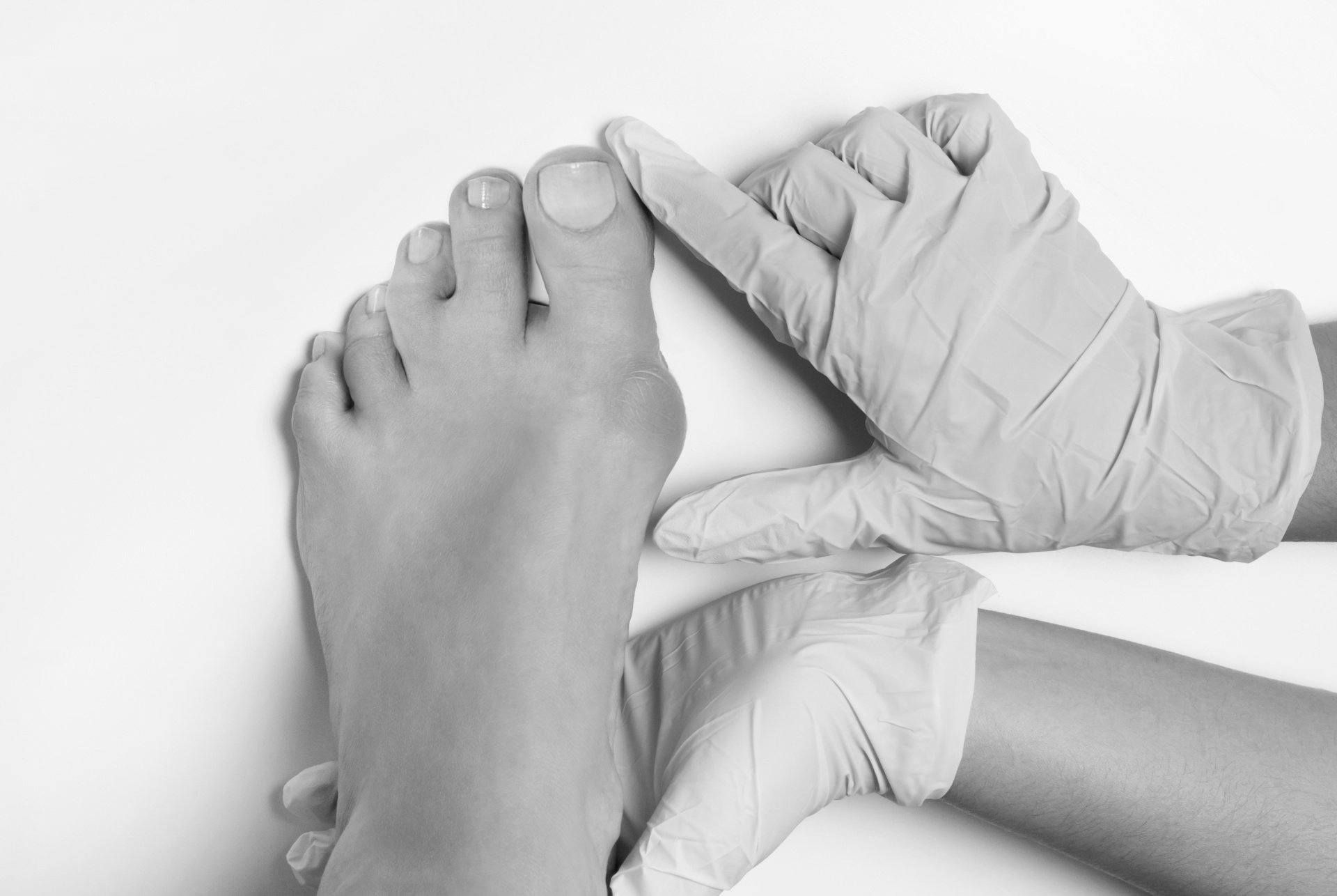 bunions