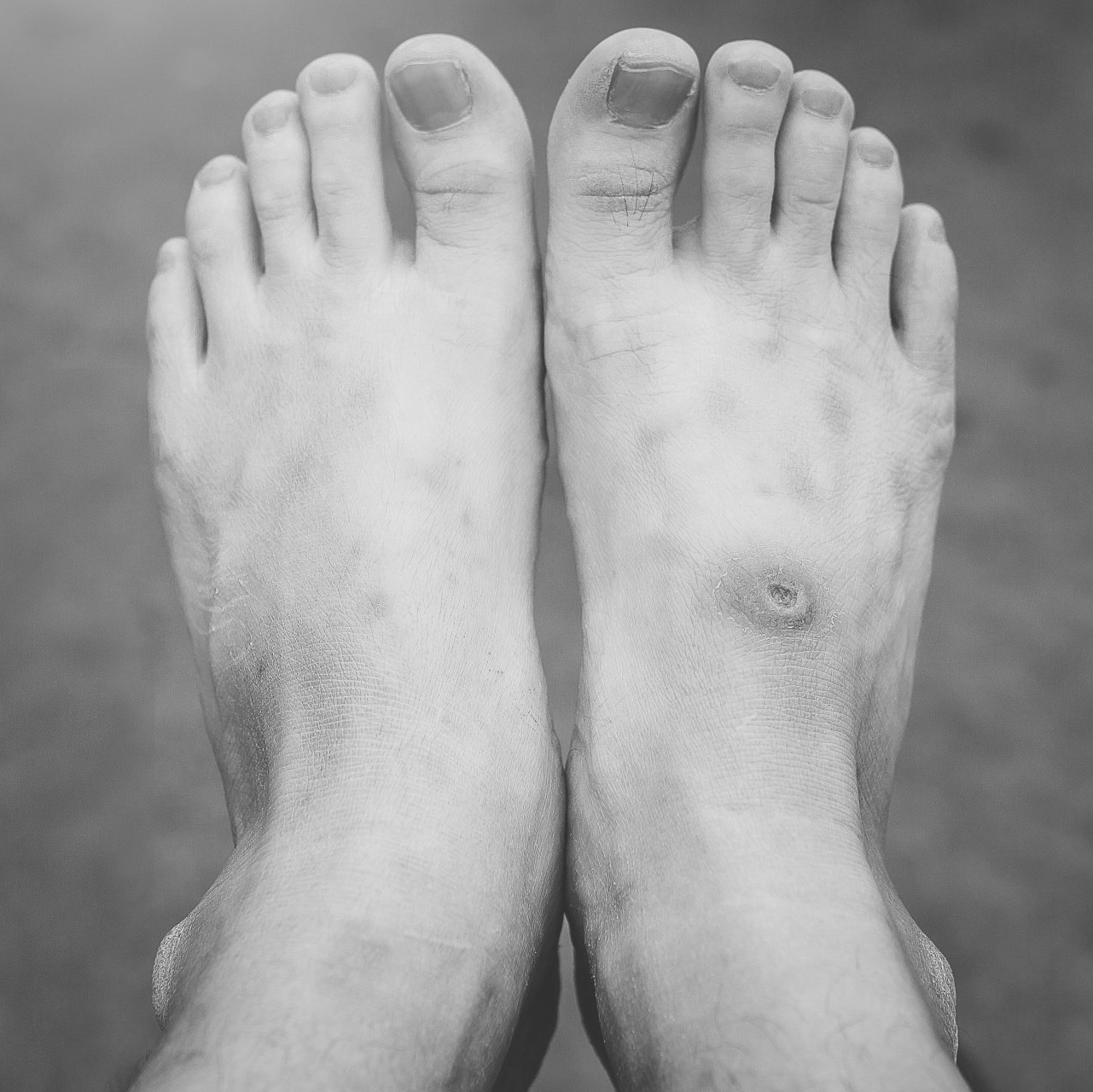 diabetic foot care