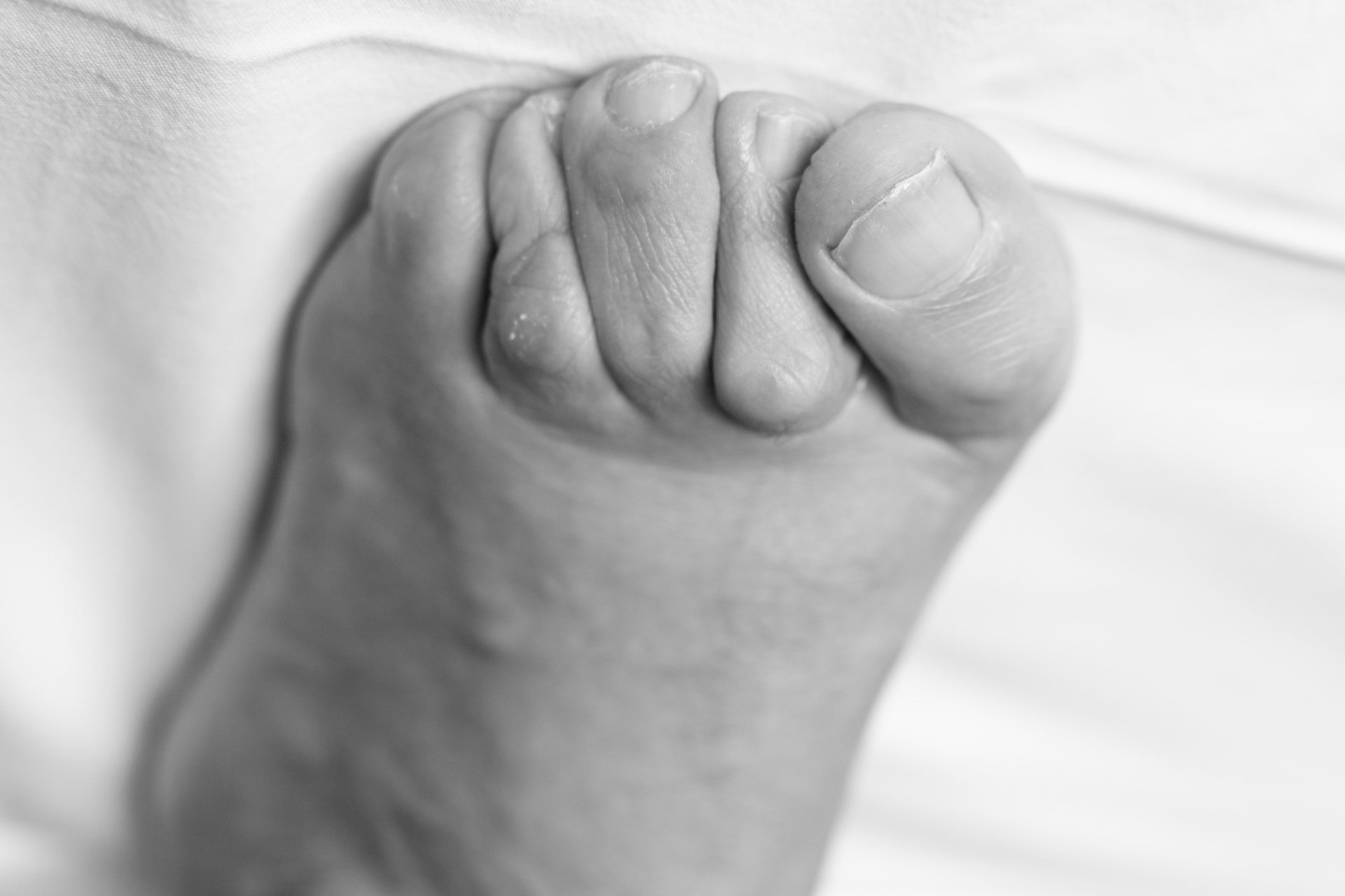 hammertoes