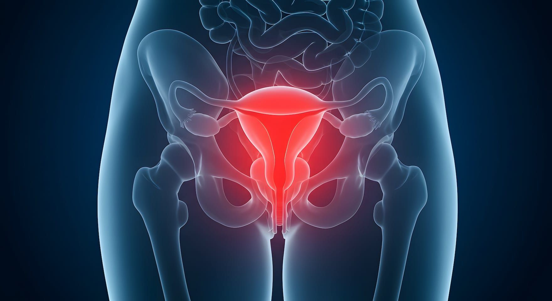 Medical illustration of a pelvis with the bladder highlighted in red, suggesting urinary system pain or inflammation