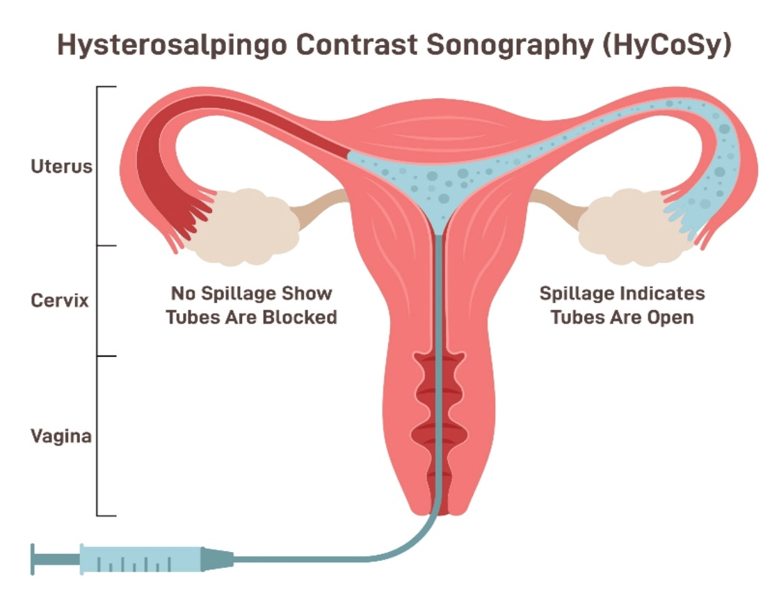 Diagram of HyCoSy showing uterus and tubes; no spill means blocked tubes, spill means open tubes