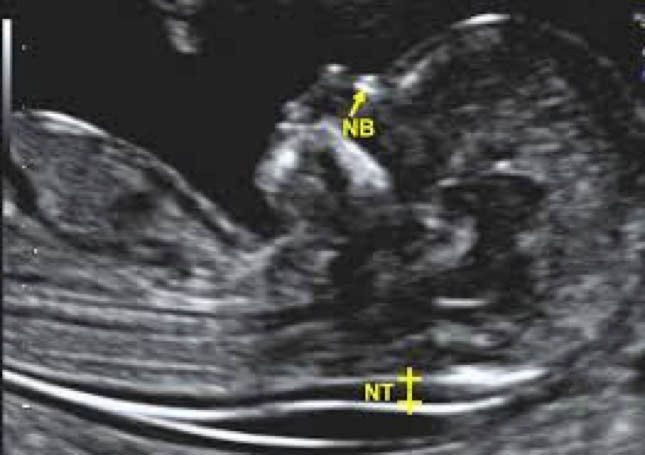 Ultrasound scan of a fetus with markers labeled NB and NT