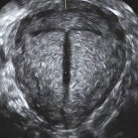 Grayscale ultrasound image of a circular structure with a dark vertical line in the center.