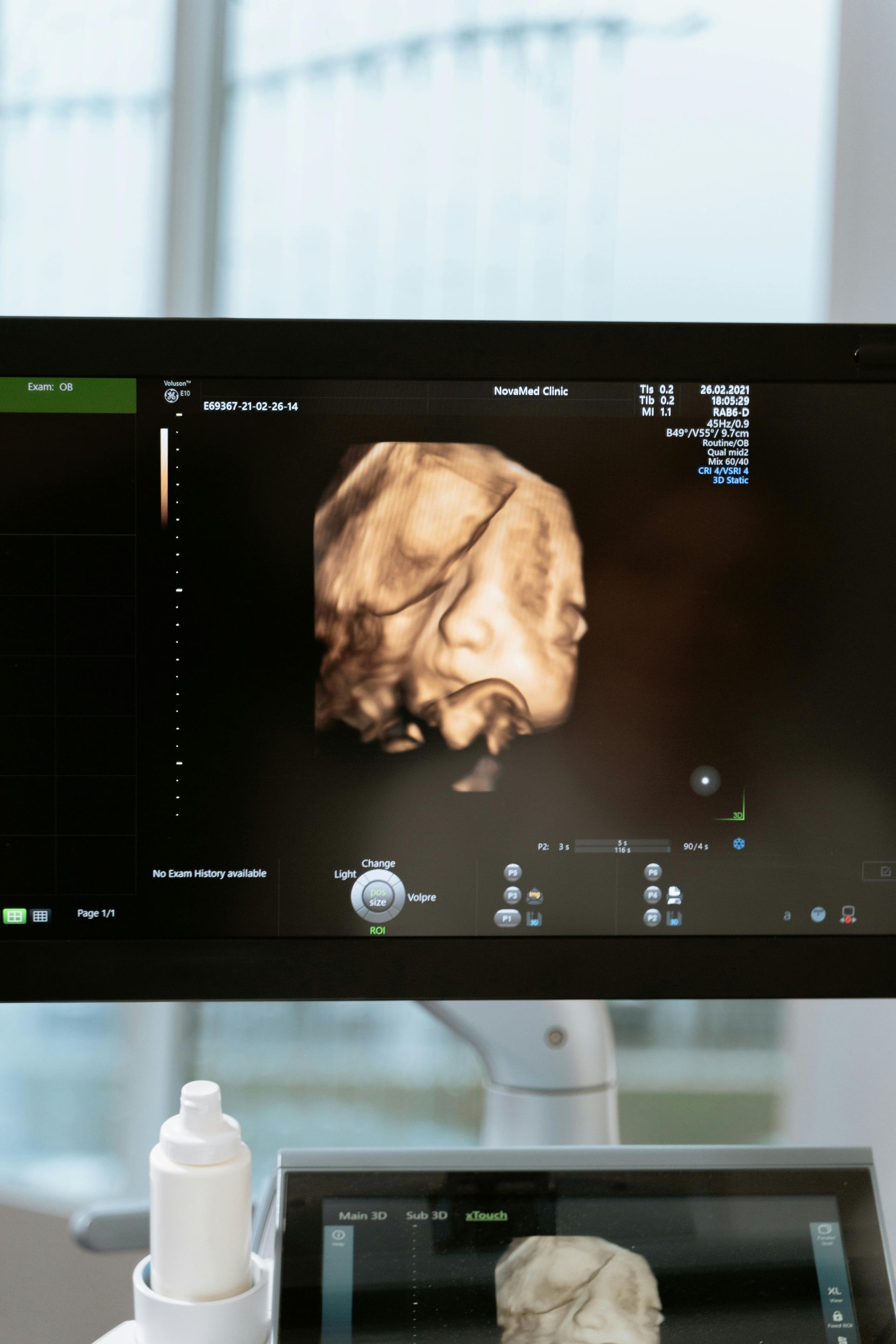 3D ultrasound scan on a medical monitor showing a fetus, with a smaller patient screen below