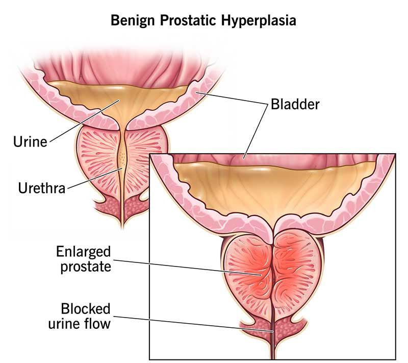 Image of enlarged prostate