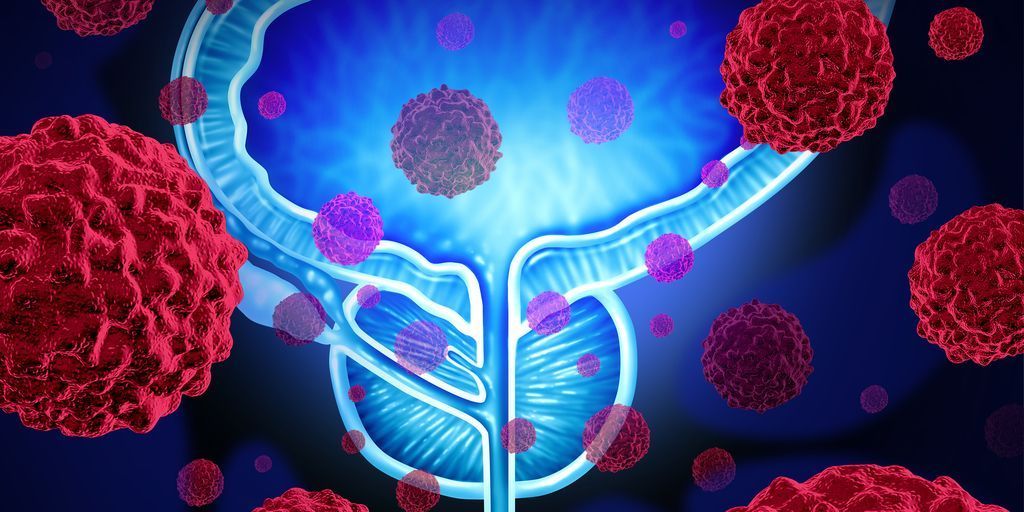 Cancer image of bladder