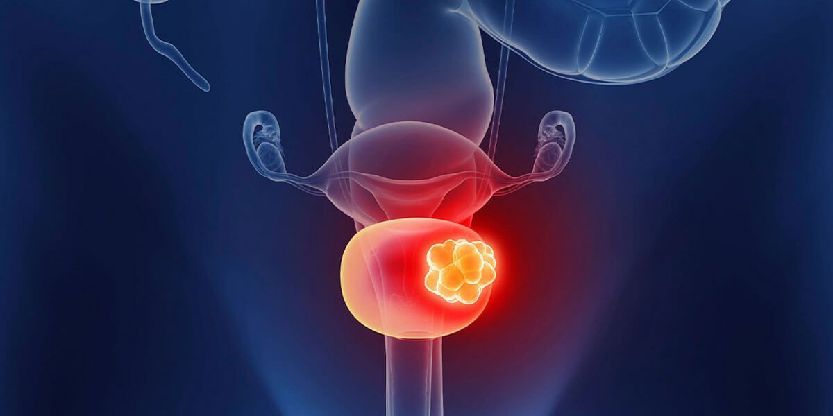 Cancer Image in Prostate