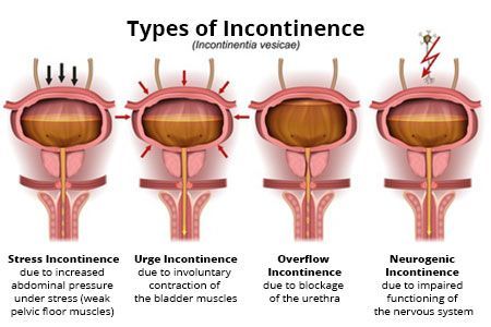 A diagram of the different types of incontinence.