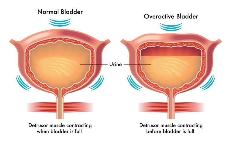 An illustration of a normal bladder and an overactive bladder