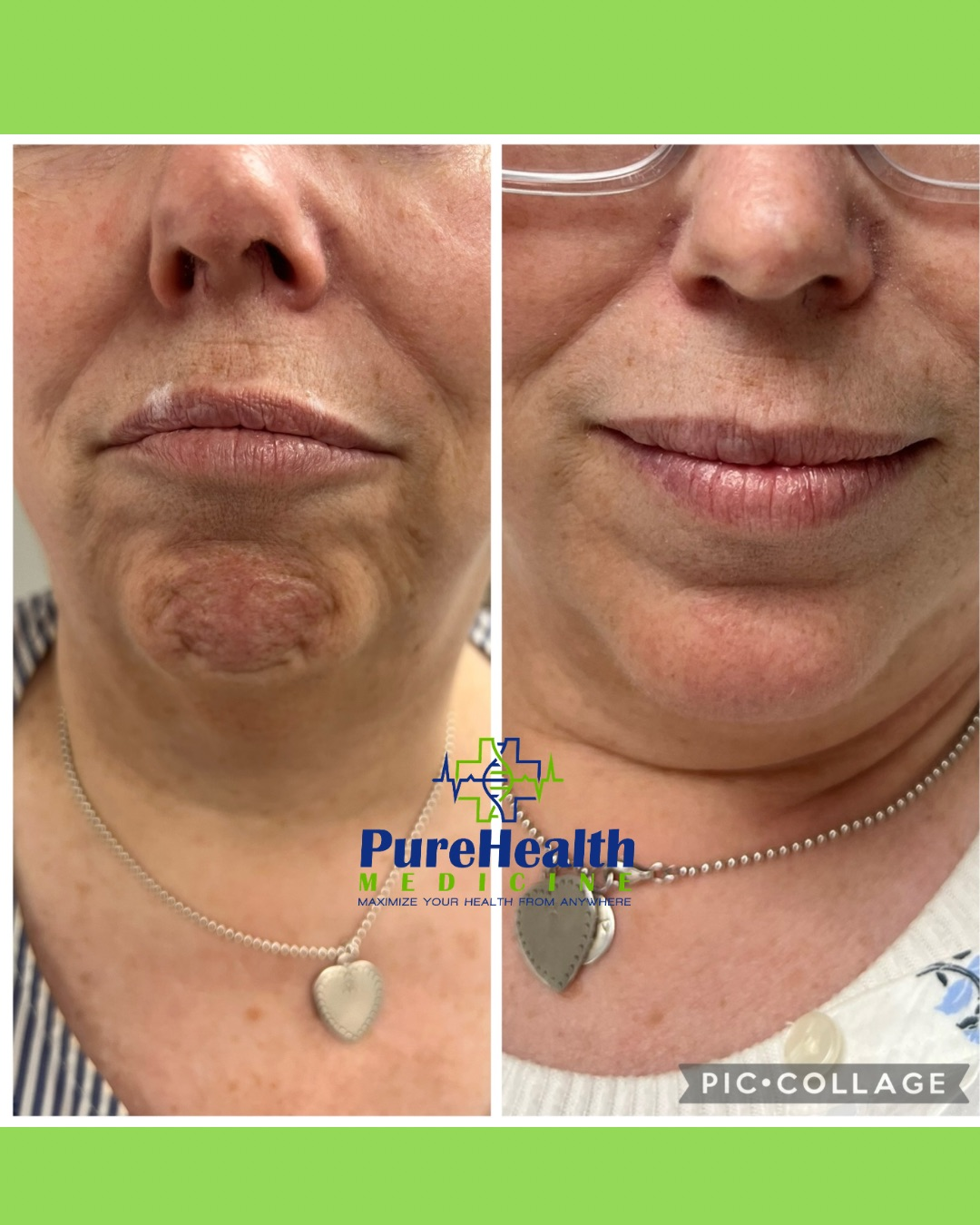 Side-by-side close-up of a woman’s lower face showing a dark neck patch before and after treatment.